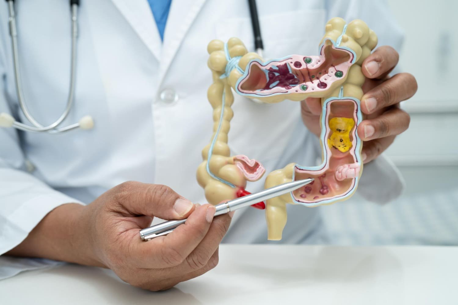 Diagnóstico y Tratamiento de Cáncer intestino grueso en CDMX | Especialistas en Cirugía Oncológica
